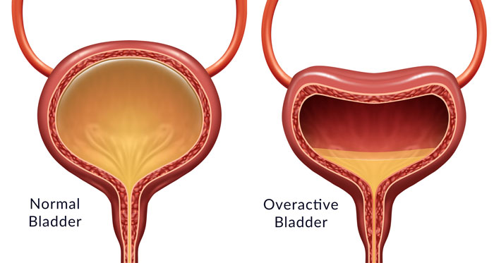 Overactive Bladder (OAB): Symptoms, Diagnosis & Treatment